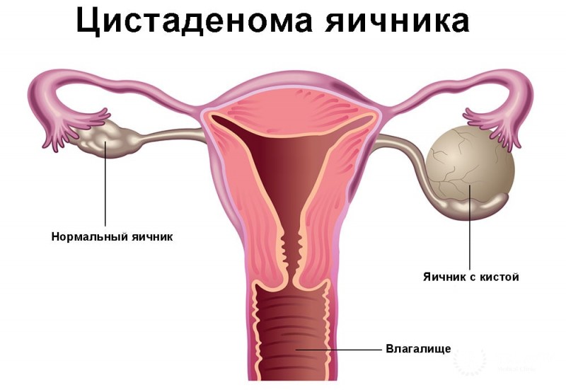 Цистаденома