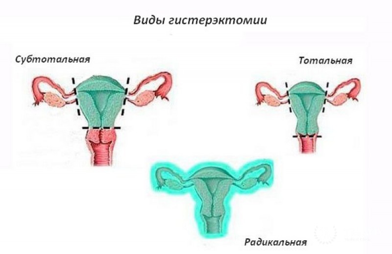 Удаление тела матки. Влагалищная гистерэктомия. Экстирпация и ампутация матки разница. Экстирпация матки с придатками.
