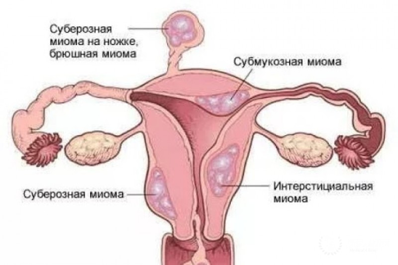 Миомэктомия
