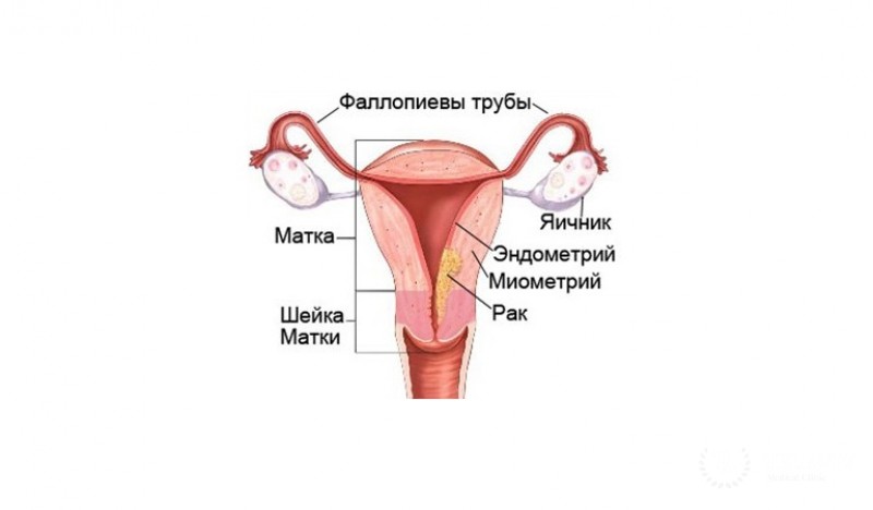 Аденокарцинома матки - полная информация