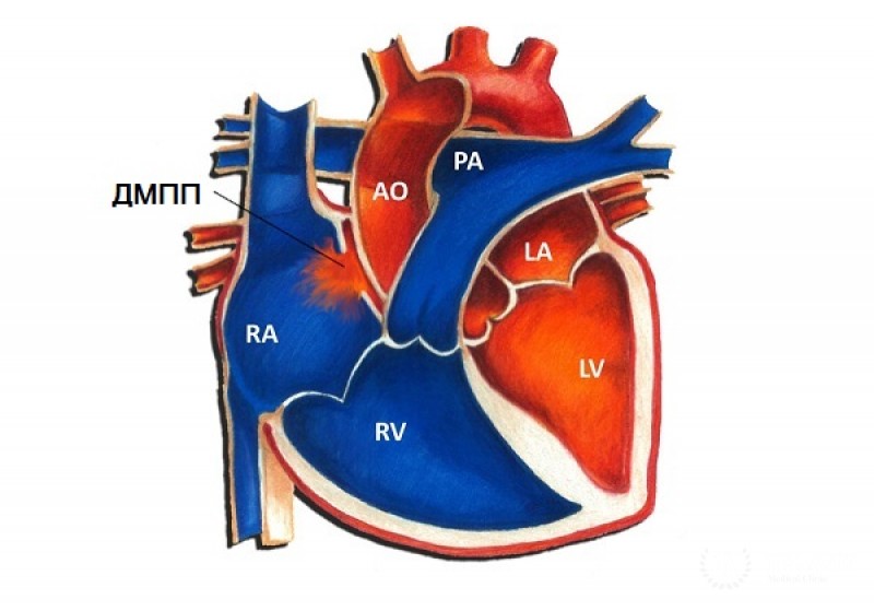 Дефект межпредсердной перегородки первичного типа у детей