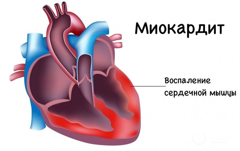 Миокардит у детей