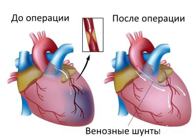 Коронарное шунтирование