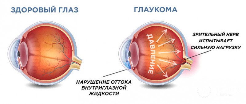 Глаукома у детей