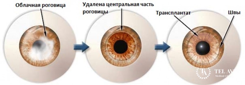Пересадка роговицы детям