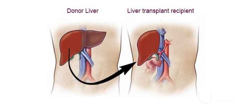 Clinic of transplantation of a liver