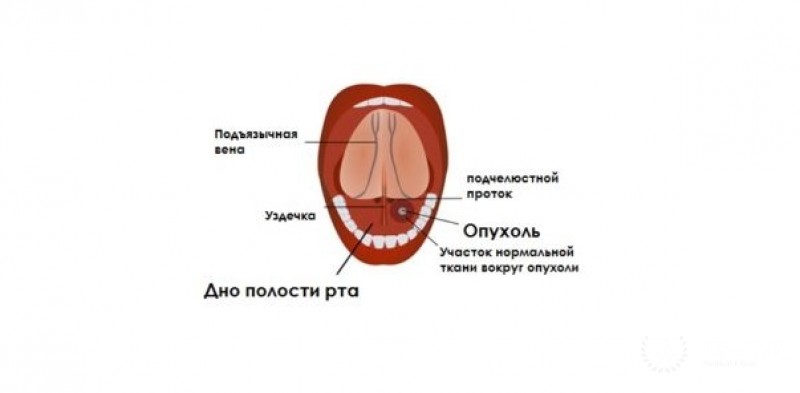 Первичная меланома в полости рта