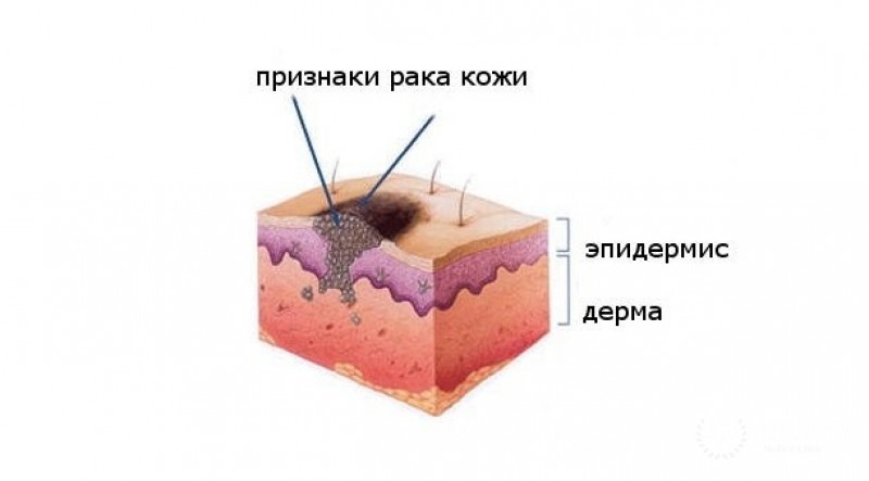 Акролентигинозная меланома