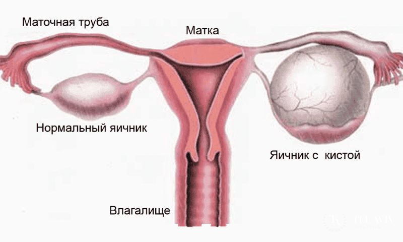 Марсупиализация кисты и абсцесса бартолиновой железы в Москве.