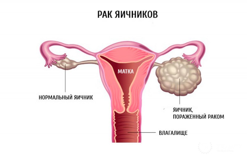 Карцинома яичника