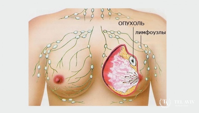 Рак молочной железы с признаками воспаления