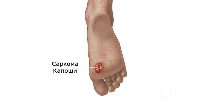 Саркома Капоши