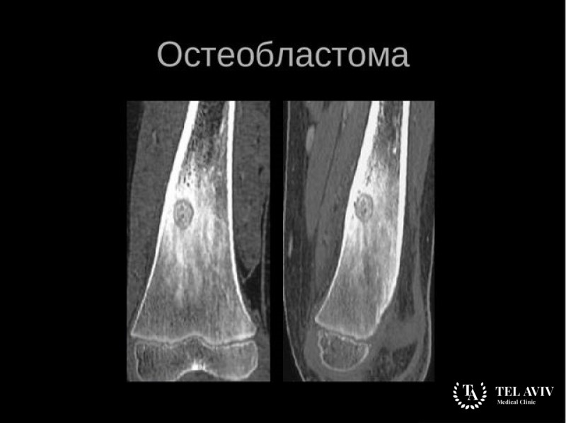 Агрессивная остеобластома
