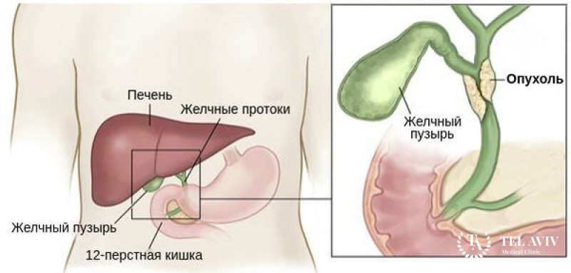 Холангиокарцинома