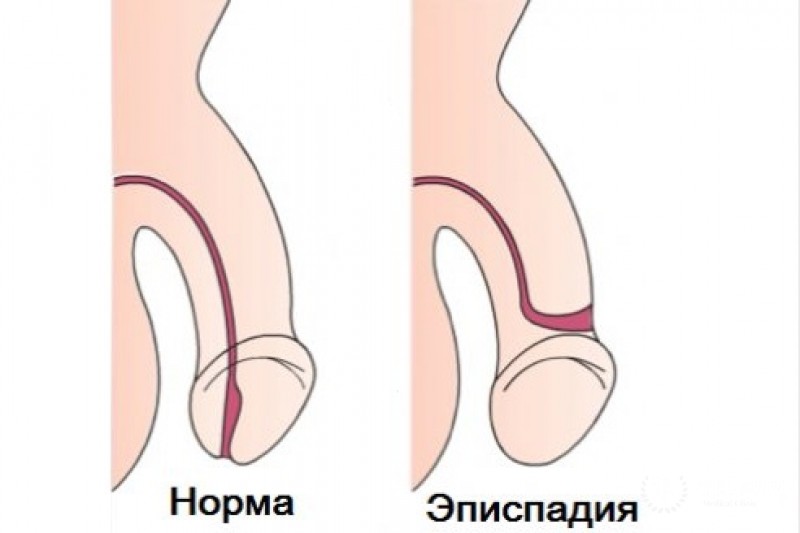 Эписпадия