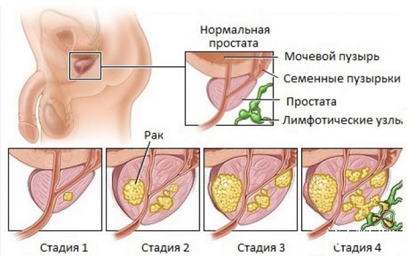 Монотерапия антагонистами гонадолиберина или антиандрогенами