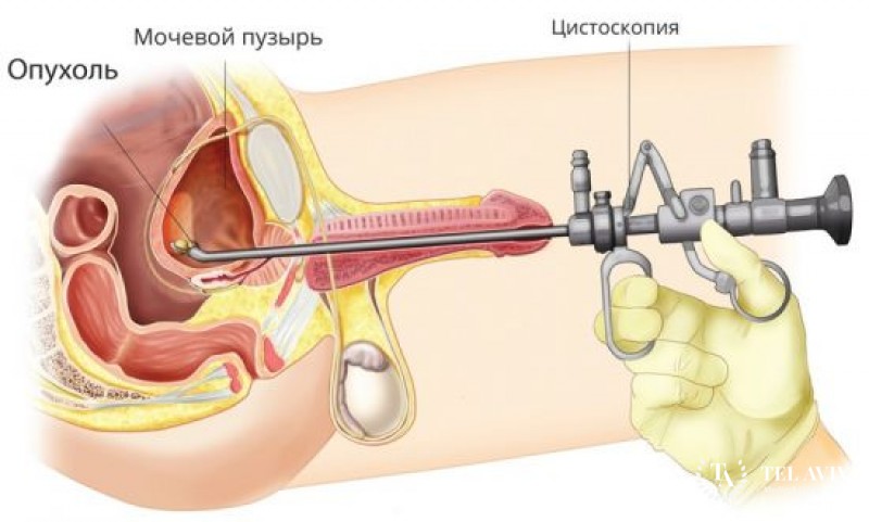 Диагностическая цистоскопия