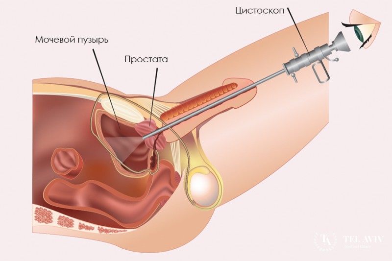 Цистоскопия с биопсией