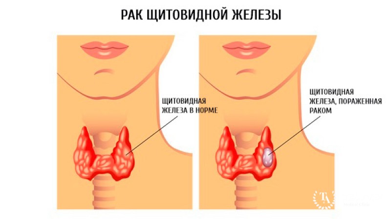 Рак щитовидной железы