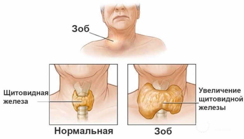 Зоб (струма)