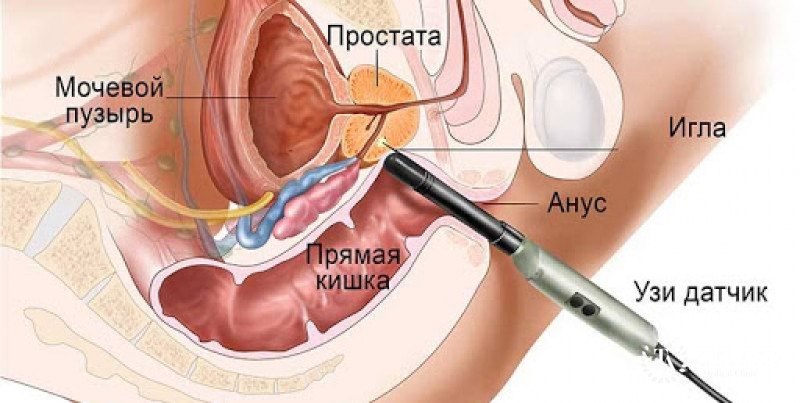 ТРУЗИ – УЗИ простаты: информация