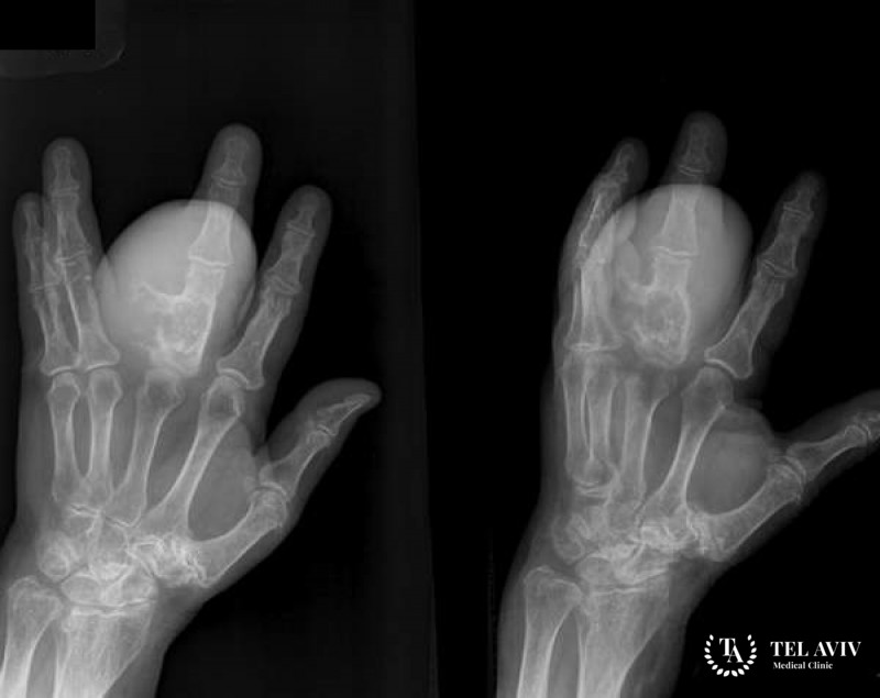 Хондросакома: полная информация