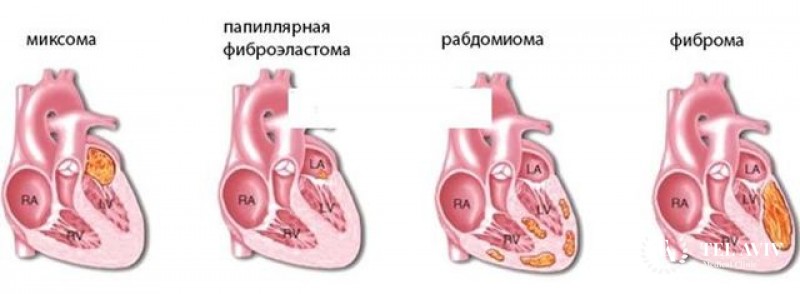 Рабдомиосаркома сердца: общая информация