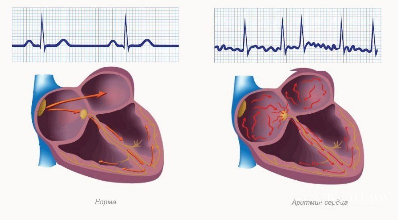 Сердечная аритмия: полная информация