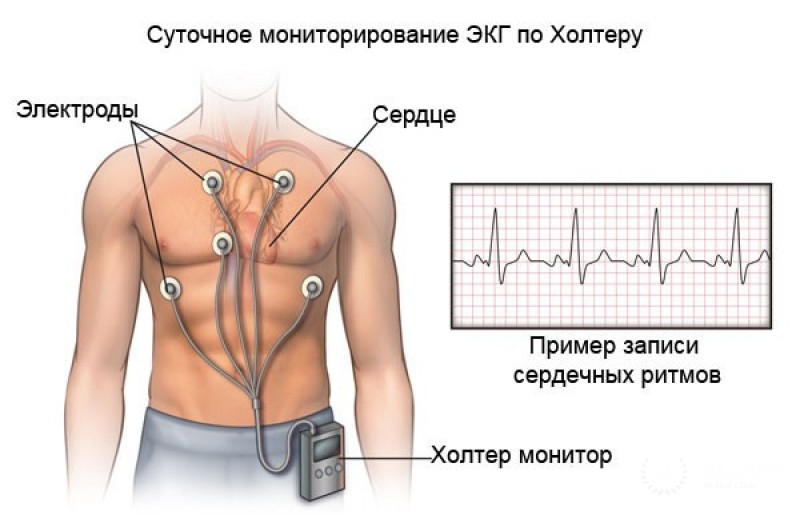 Суточное мониторирование ЭКГ: полная информация