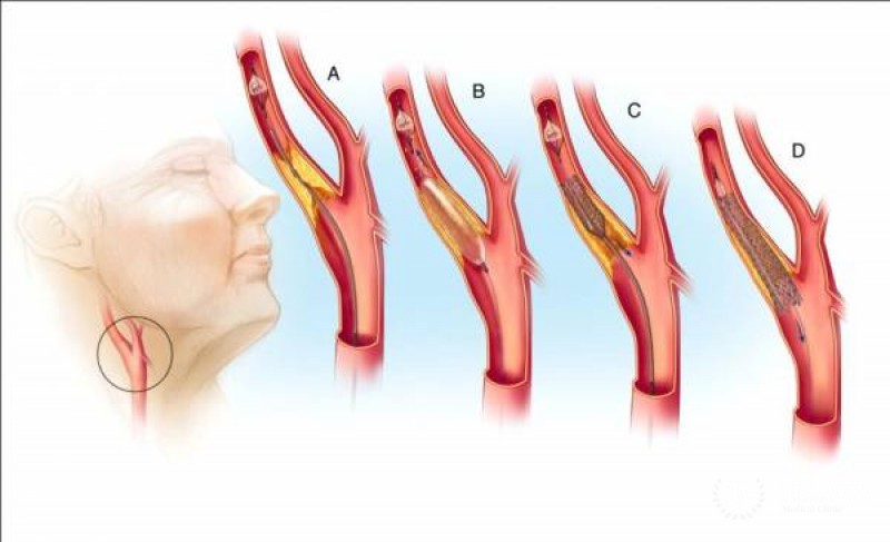 Стентирование сонных артерий: общая информация