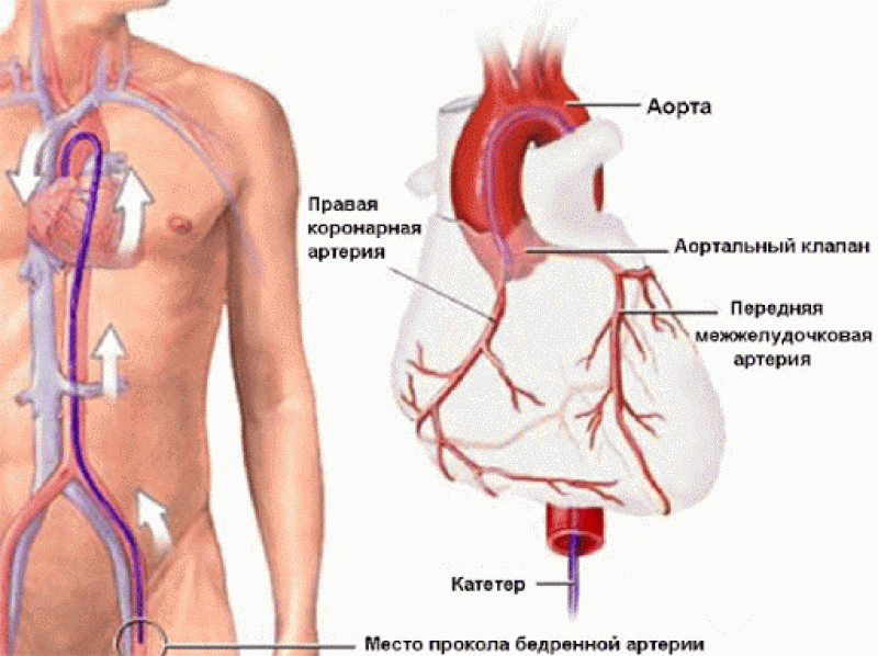 Катетеризация сердца: полная информация