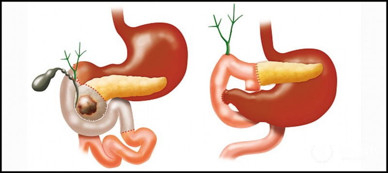 Pancreatic Cancer Surgery