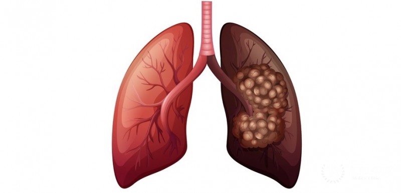 Lung Cancer Pulmonary neuroendocrine tumors