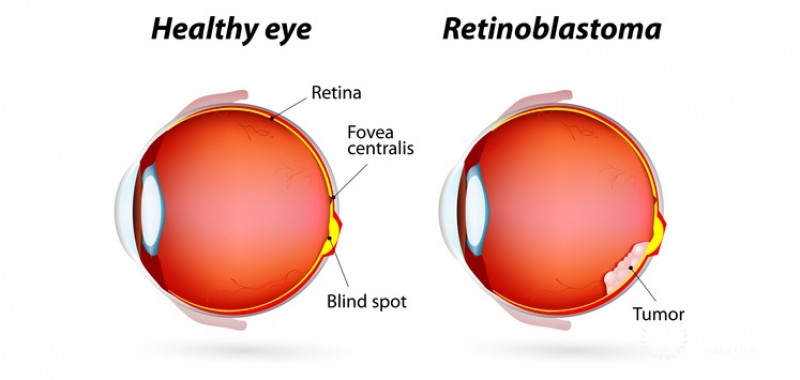 Retinoblastoma
