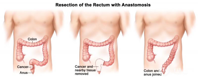 rectal tumor