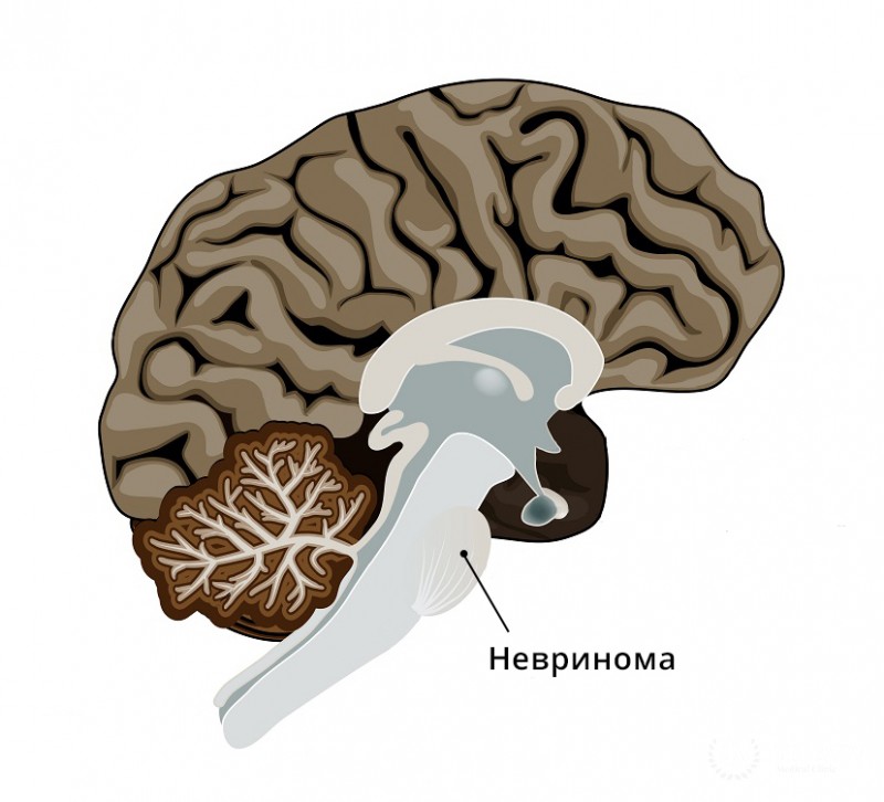 Невринома - диагностика и лечение