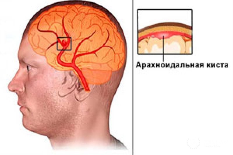 Арахноидальная киста - что это