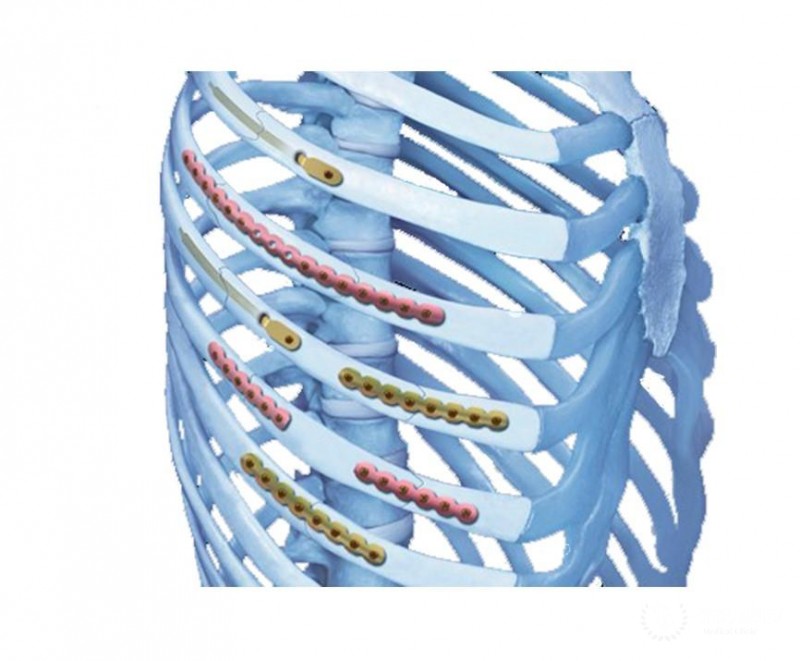 Эндопротезирование ребер и грудины