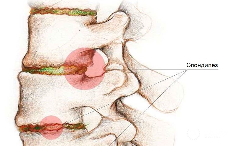 Спондилез – признаки, диагностика, лечение