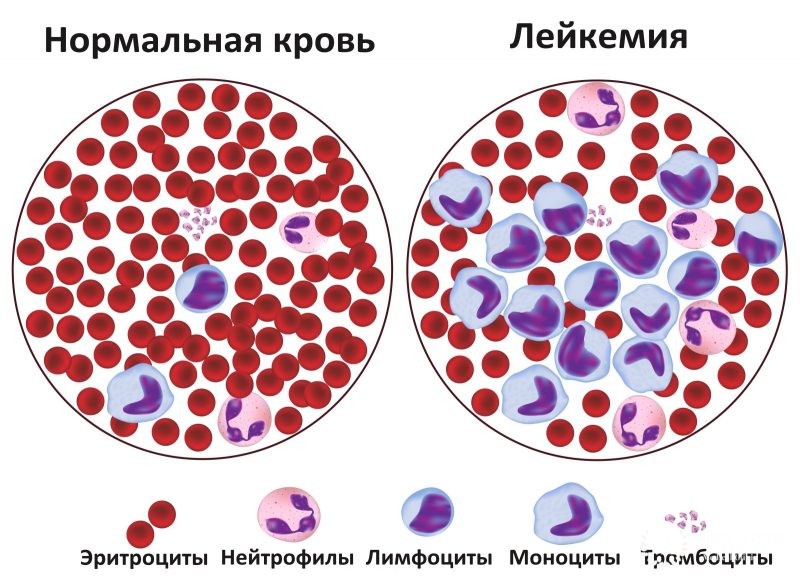 Хронический базофильный лейкоз