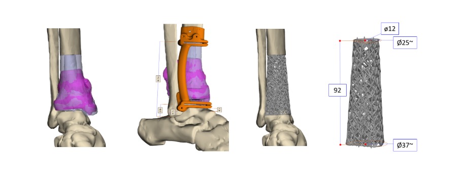 3D-реконструктивная хирургия в онкоортопедии